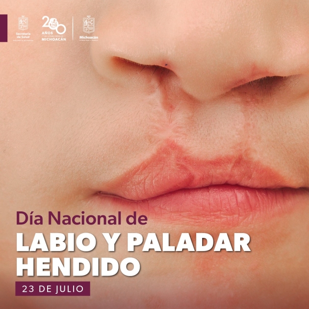SSM previene y atiende el labio y paladar hendido         